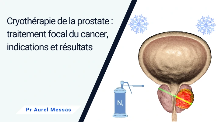 Cryothérapie de la prostate, un traitement focal du cancer: indications et résultats