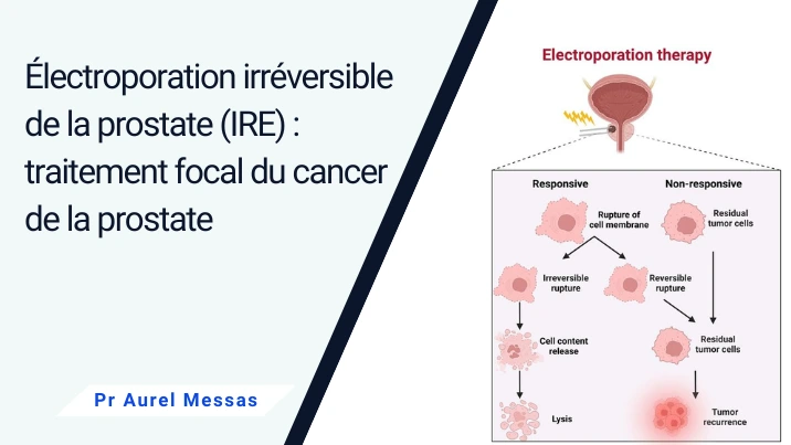 Électroporation irréversible de la prostate (IRE) : traitement focal du cancer de la prostate